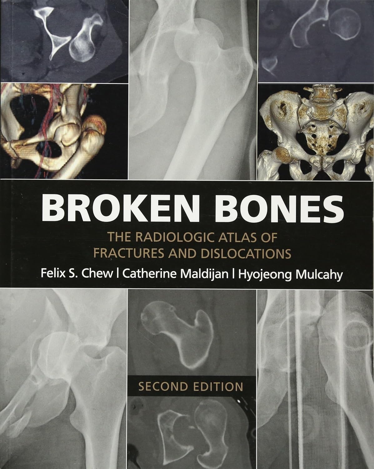 Broken Bones: The Radiologic Atlas of Fractures and Dislocations